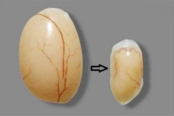 Teo tinh hoàn: Cách xác nhận thay đổi và đánh giá chức năng