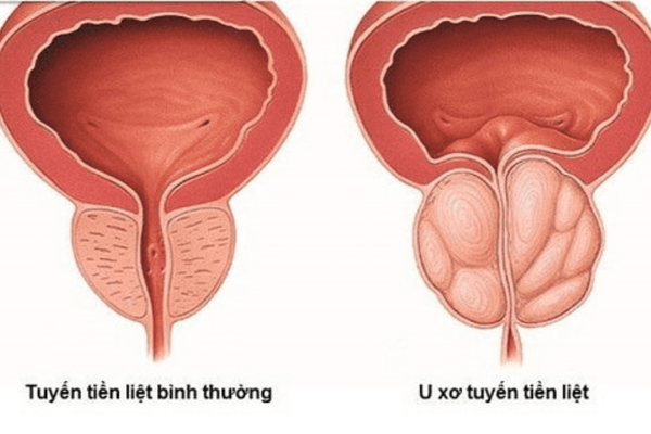 Nang tuyến tiền liệt: đánh giá hình ảnh và hướng theo dõi