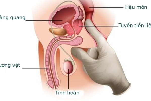Viêm tuyến tiền liệt: triệu chứng và cách tiếp cận điều trị