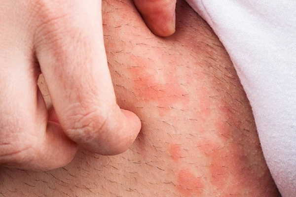 Ngứa lông mu: phân biệt rận, kích ứng và bệnh da trước điều trị