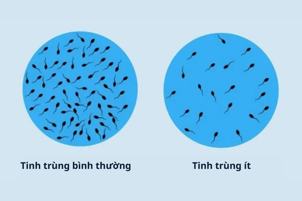Bất thường tinh trùng: Phân biệt dấu hiệu và kết quả xét nghiệm